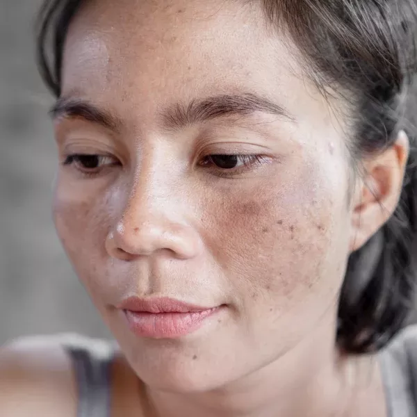 Esthetician’s Role In Managing Hyperpigmentation